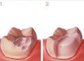 Inlays and onlays