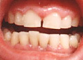 a very thin layer of ceramic is applied to teeth
