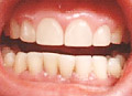 The colour can be exactly matched to that of the surrounding teeth.