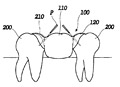 A dental bridge consists of an artificial tooth fused between two crowns.