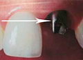 A dental bridge consists of an artificial tooth fused between two crowns.