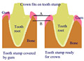 Dental crown