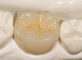 Dental crown