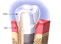Dental implants The device consists of a titanium screw