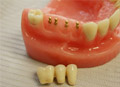 Dental implants