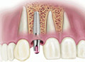 Dental implants