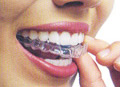 Invisalign