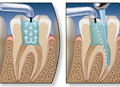 Root canal surgery