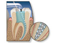 Root canal surgery