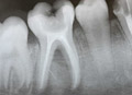 Root canal surgery