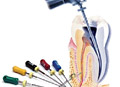 Root canal surgery