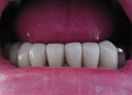 Dental crown close space