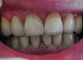 Dental crown close space