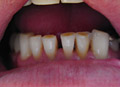 Dental crown close space