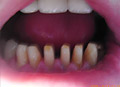 Dental crown close space