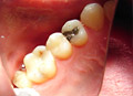 Dental crowns show case