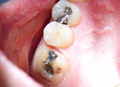 Dental crowns show case