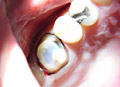 Dental crowns show case