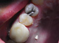 Dental crowns show case