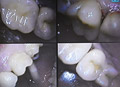 Dental crowns show case