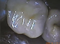 Dental crowns show case