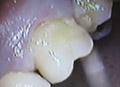 Dental crowns show case