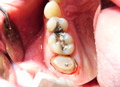 Dental crowns show case