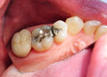 Dental crowns show case