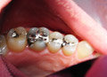 Dental crowns show case