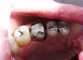 Dental crowns show case