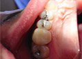 Dental crowns show case