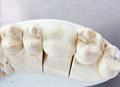 Dental crowns show case