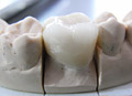 Dental crowns show case