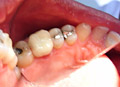 Dental crowns show case