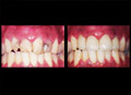 Veneer crown