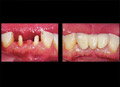 Veneer crown