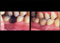 Veneer crown