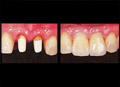 Veneer crown