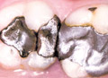 Tooth coloured fillings