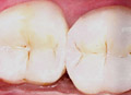 Tooth coloured fillings