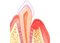 Suportive bone around the root is diseased and partially destroyed.