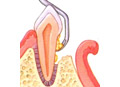 First, plaque and tartar are removed from the infected pocket.