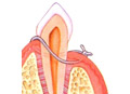 The gum is then closed over reshaped bone at or below the original gumline.